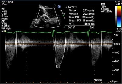 Reversal of Bioprosthetic Aortic Valve Thrombosis Using Rivaroxaban—A Case Report